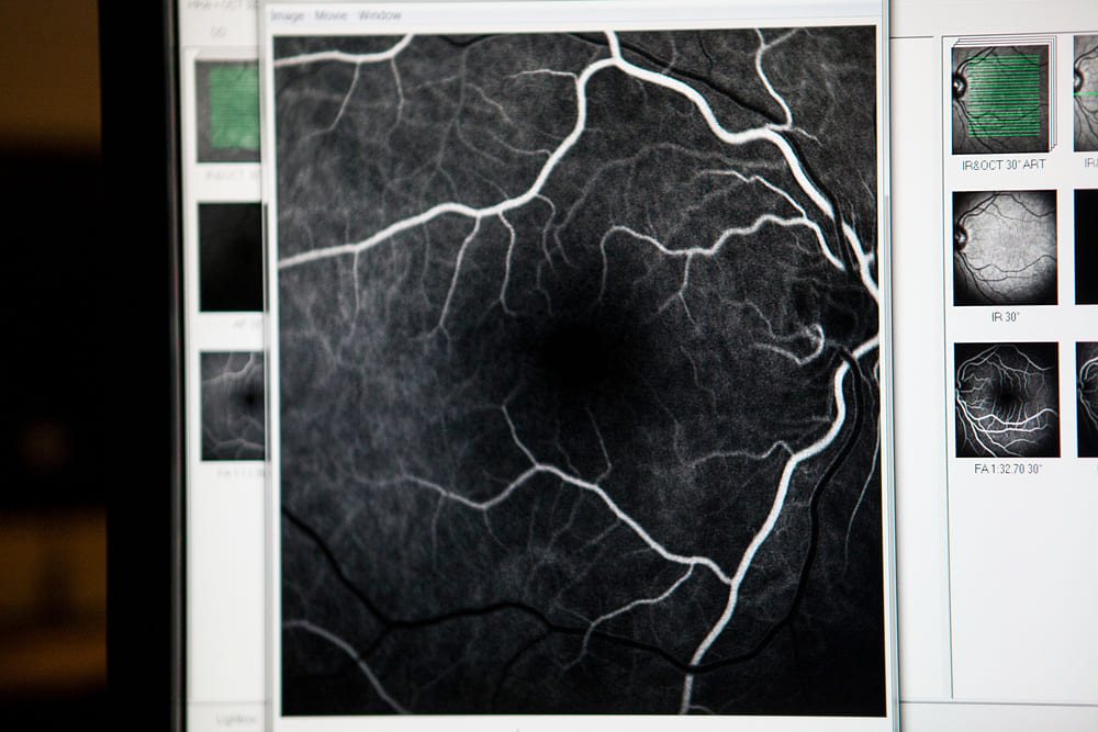 Schwarz-weiße Darstellung der Blutgefäße im Auge bei einer Fluoreszenzangiografie oder OCT-Angiografie auf einem Monitor.