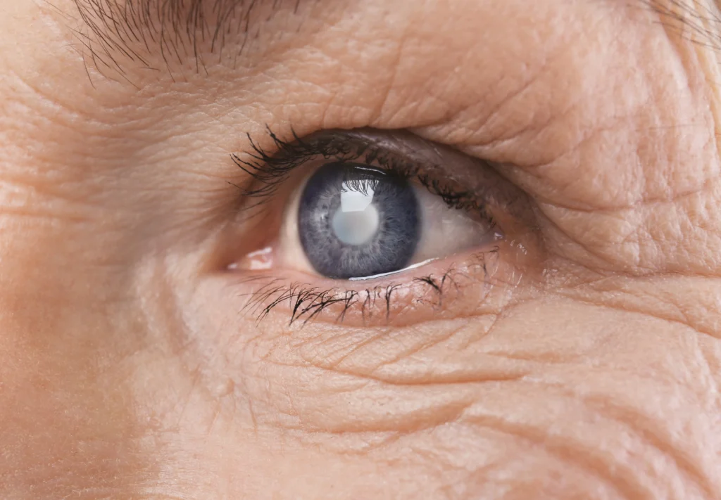 Nahaufnahme des blauen Auges einer älteren Person mit grauem Star (Katarakt) und umliegenden Falten.